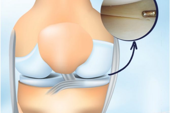 Cartilagem Articular